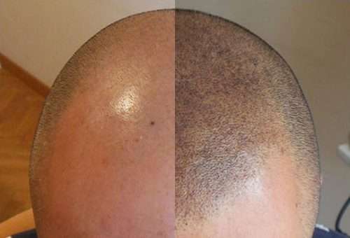 Scalp Micro Pigmentation in Pattaya, Thailand