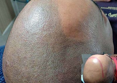 Scalp Micro Pigmentation in Pattaya,Thailand