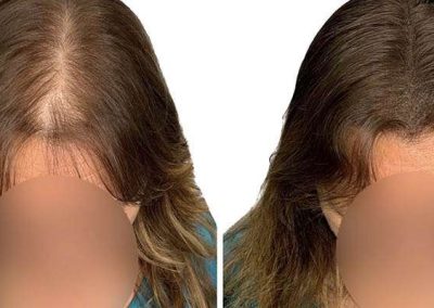 Scalp Micro Pigmentation in Pattaya,Thailand