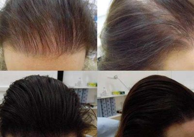 Scalp Micro Pigmentation in Pattaya,Thailand