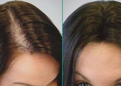 Scalp Micro Pigmentation in Pattaya,Thailand