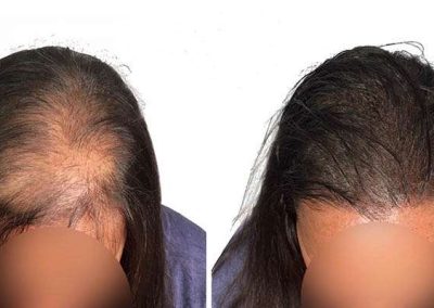 Scalp Micro Pigmentation in Pattaya,Thailand