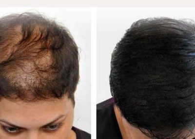 Scalp Micro Pigmentation in Pattaya,Thailand