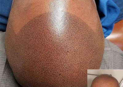 Scalp Micro Pigmentation in Pattaya,Thailand