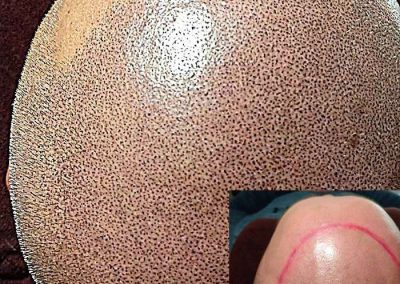 Scalp Micro Pigmentation in Pattaya,Thailand