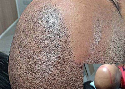 Scalp Micro Pigmentation in Pattaya,Thailand