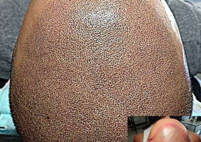 Scalp Micro Pigmentation in Pattaya,Thailand