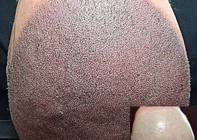 Scalp Micro Pigmentation in Pattaya,Thailand