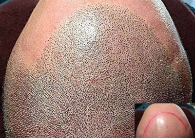 Scalp Micro Pigmentation in Pattaya,Thailand