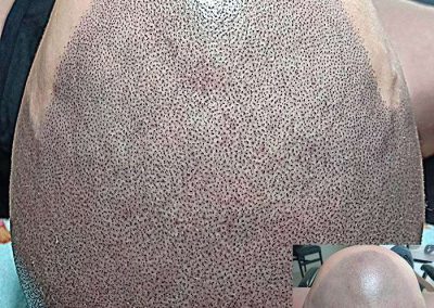 Scalp Micro Pigmentation in Pattaya,Thailand