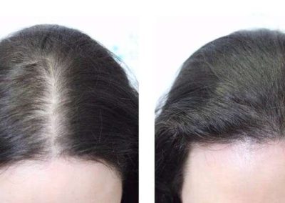 Scalp Micro Pigmentation in Pattaya,Thailand